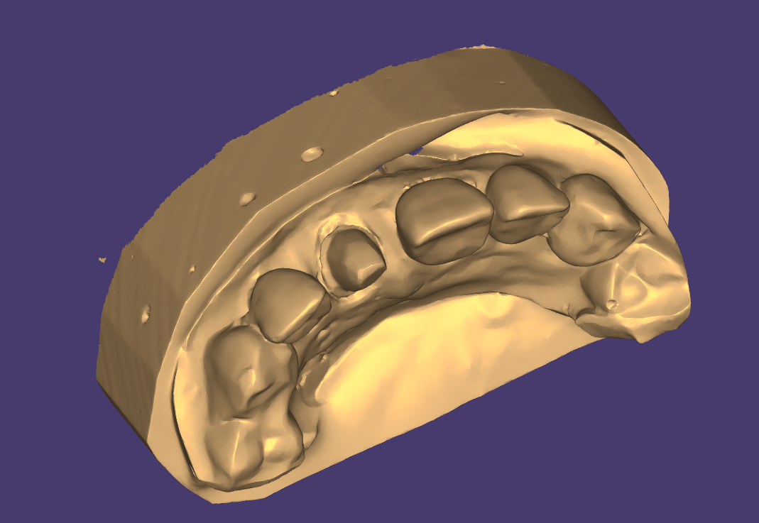 Expert in crown and bridge designs